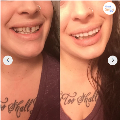 Snap-On Dentures