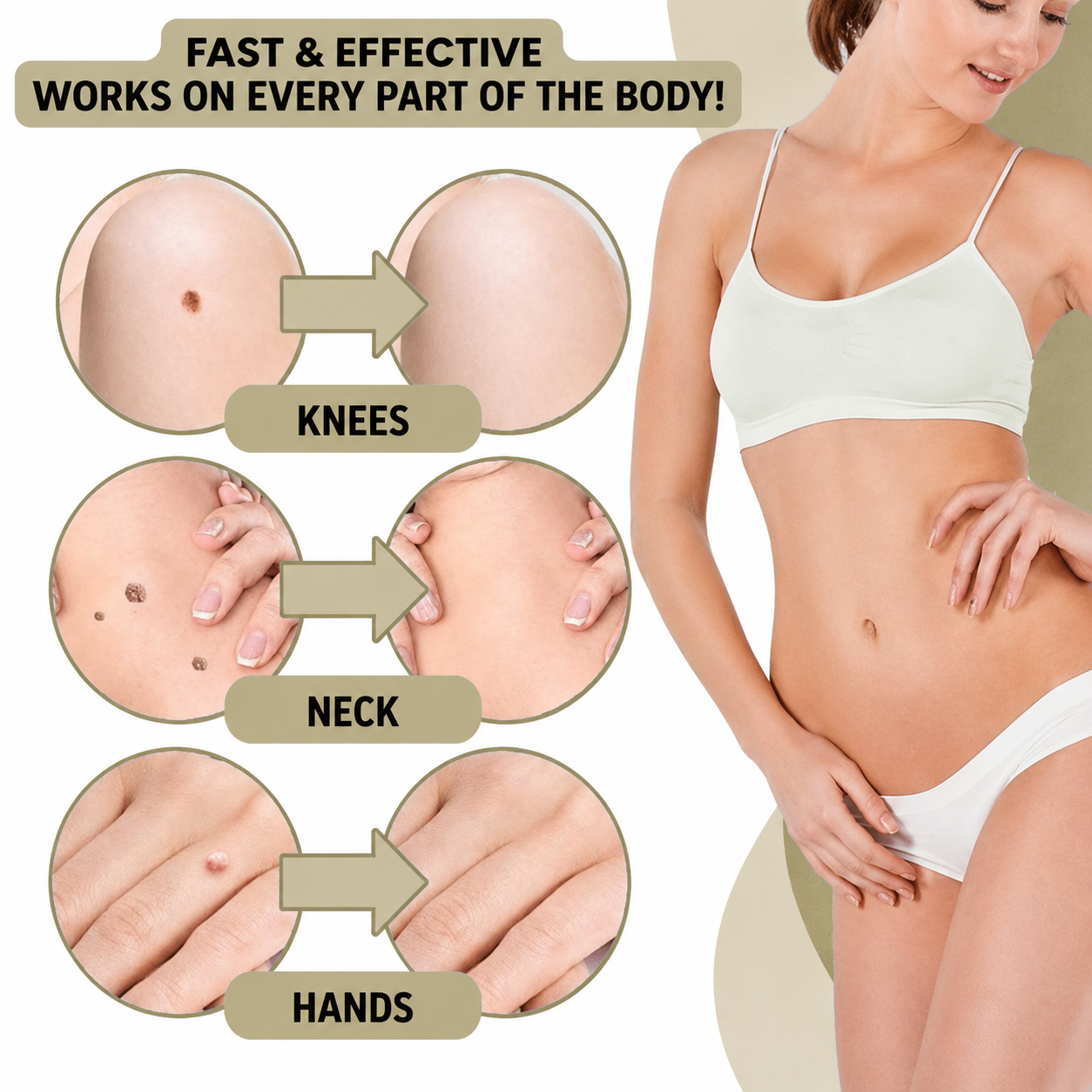 Wart Remover | Pain-Free Removal of Warts & Moles | For Home Use | No Surgery Required