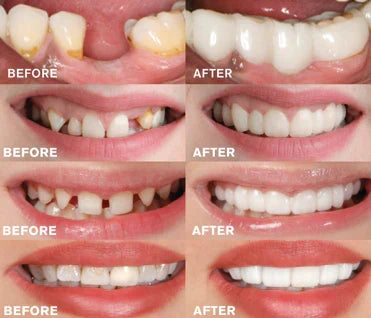 Snap-On Dentures